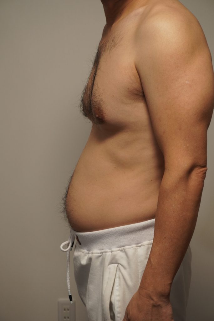 50代胸毛へそ毛。脱毛前。横