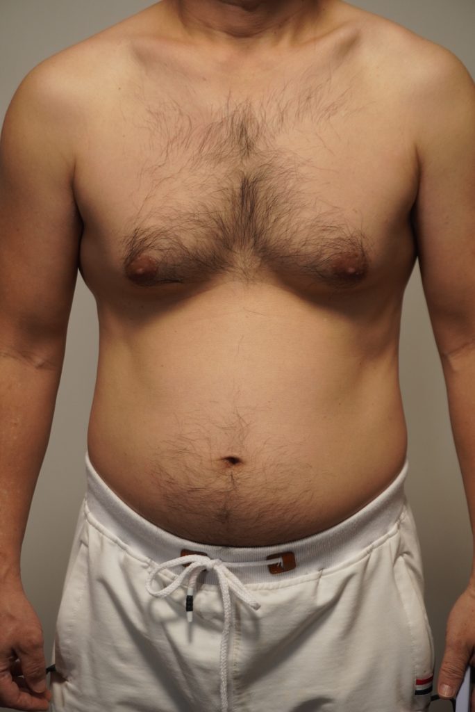 50代胸毛へそ毛。脱毛前。正面