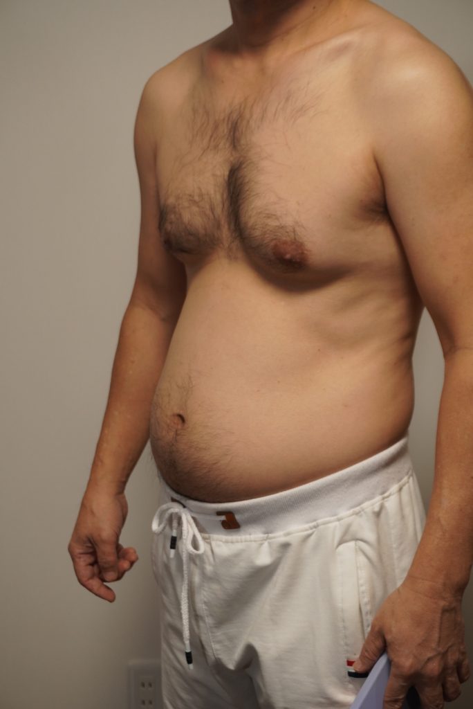 50代胸毛へそ毛。脱毛前。斜め