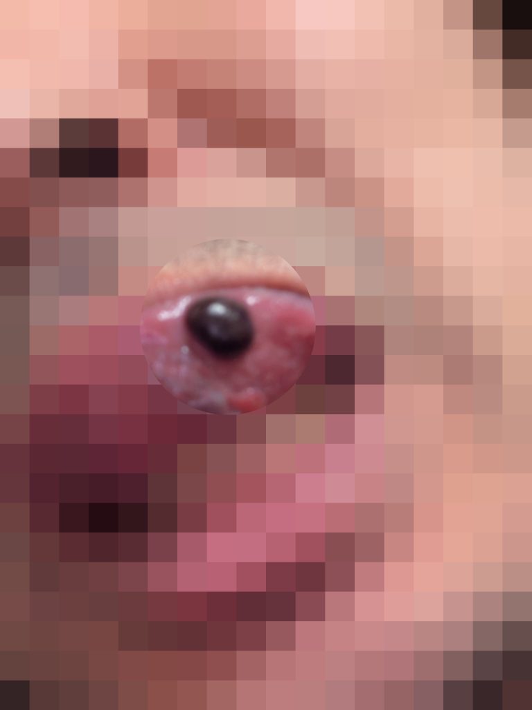 口の中に血豆が出来た。口腔内血疱